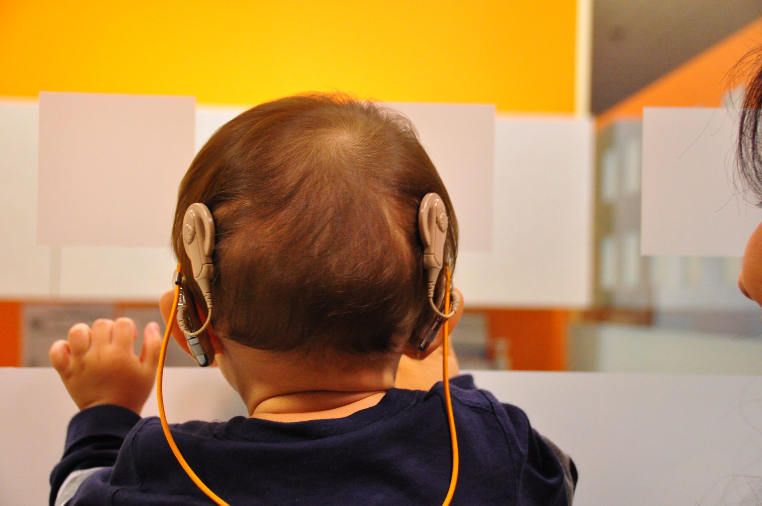 Cochlear Implants in Child