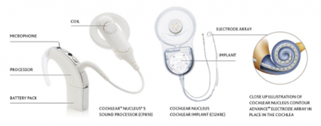 Cochlear Implant CI3