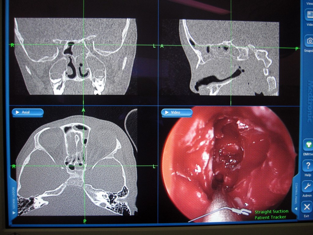 Guided Functional Endoscopic Sinus Surgery