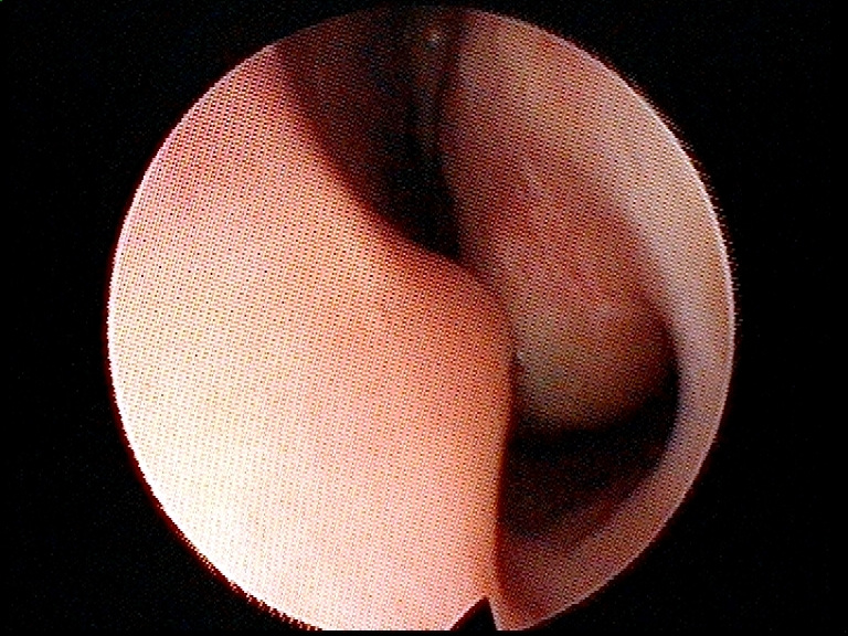 Deviated nasal septum