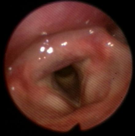 gastric acid reflux laryngitis