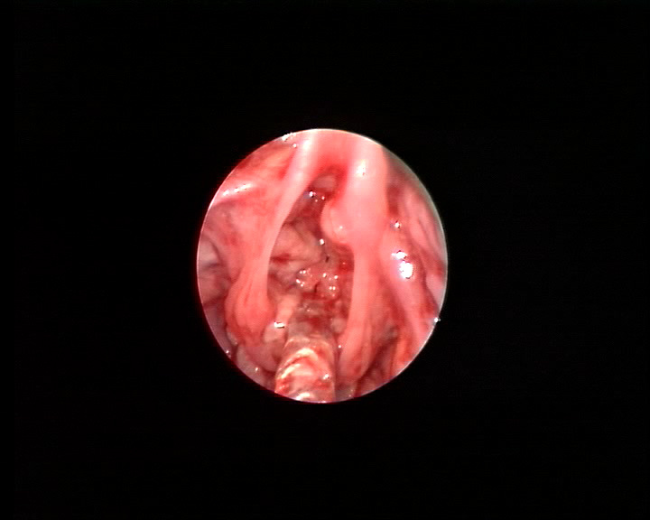 Airway papillomatosis