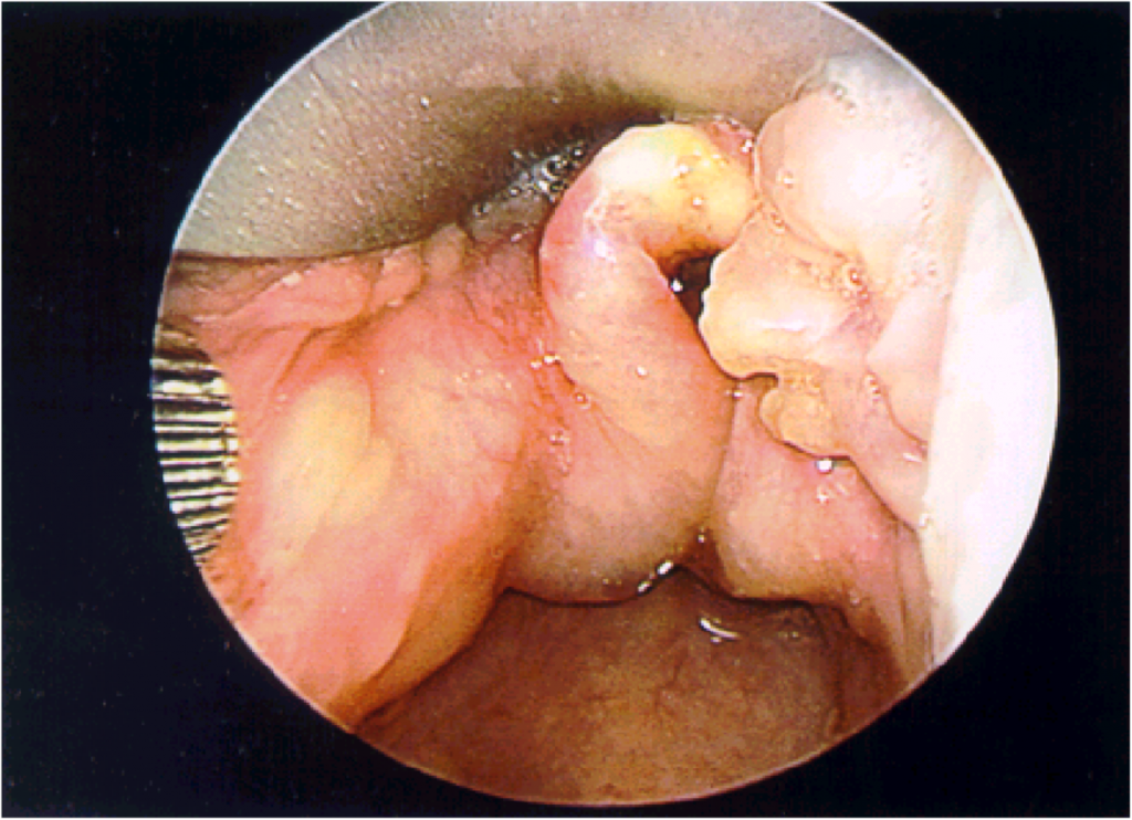 laryngeal lymphangioma