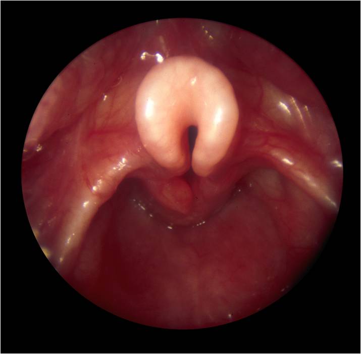 laryngomalacia