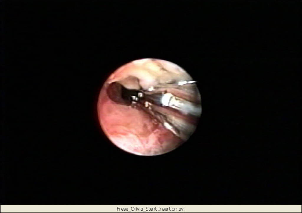 balloon dilatation for mild subglottic stenosis