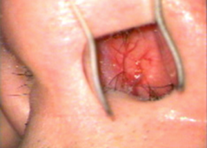 Nasal Septum