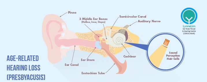 Age Related Hearing Loss