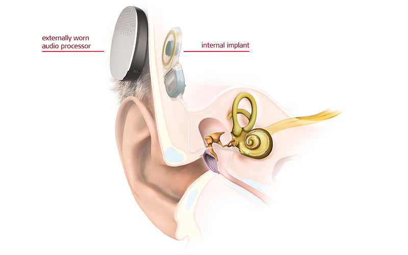BAHS - Bone Anchored Hearing Systems/AIDS- BAHA