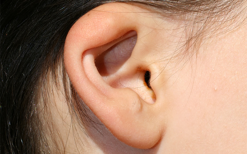 Deformed Ear in Children
