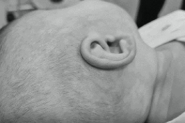 Ear Well for Malformed / Deformed Ears