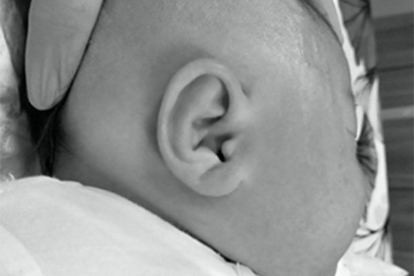 Ear Well for Malformed /Deformed Ears