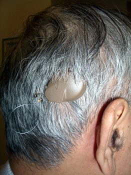 VSB Middle Ear Implant